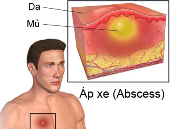 Áp xe là gì? Phương pháp điều trị áp xe hiệu quả