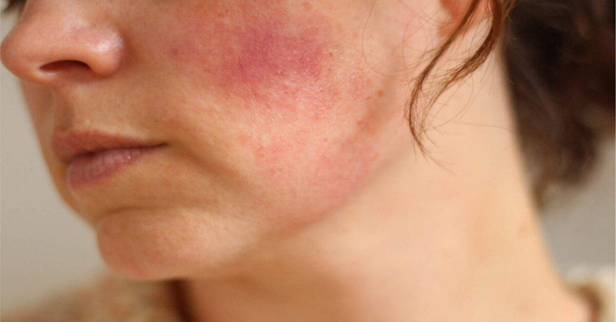 Hướng dẫn chăm sóc da bị kích ứng mỹ phẩm hiệu quả